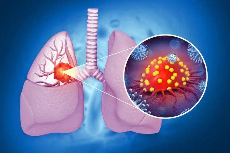  肺癌高发背景下，我们该如何避开饮食雷区？ 健康养生