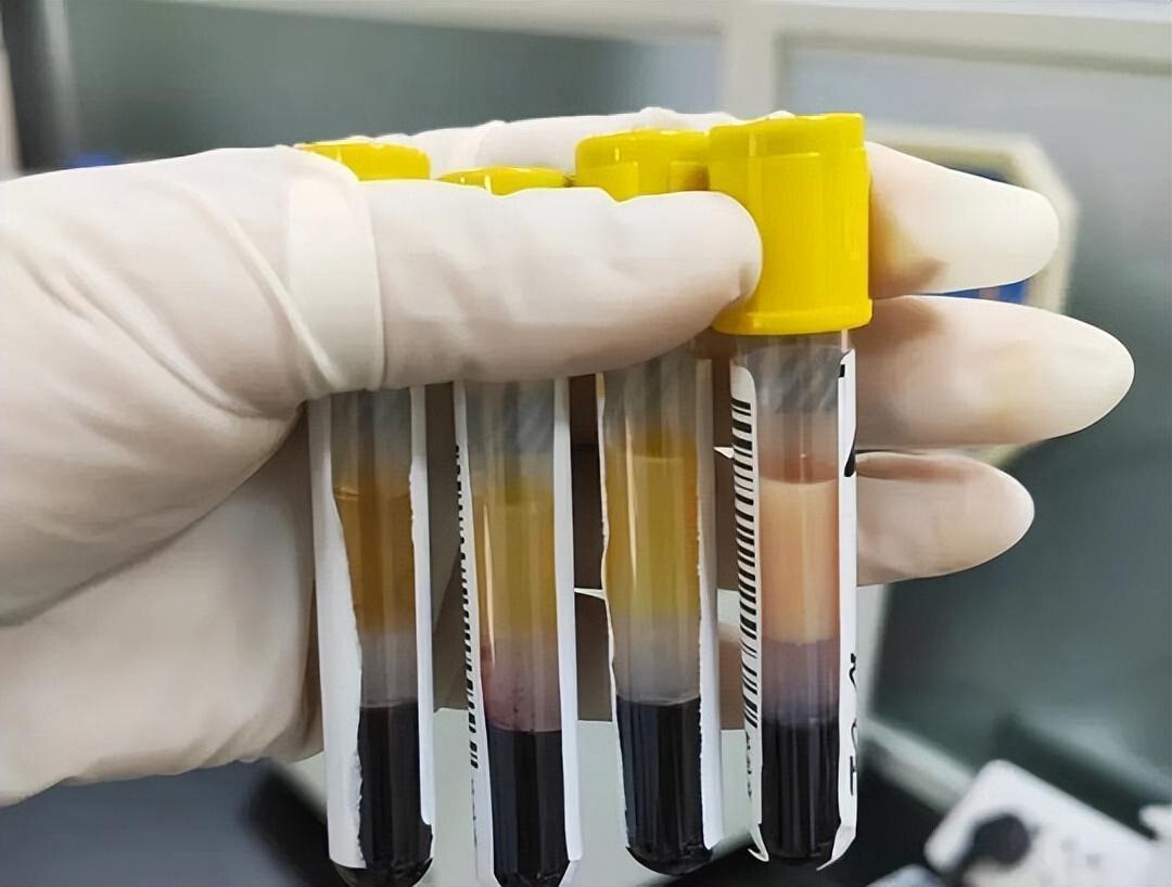  【临床警示】被忽视的脂质沉积体征：五个高血脂早期信号的专业解读 健康养生