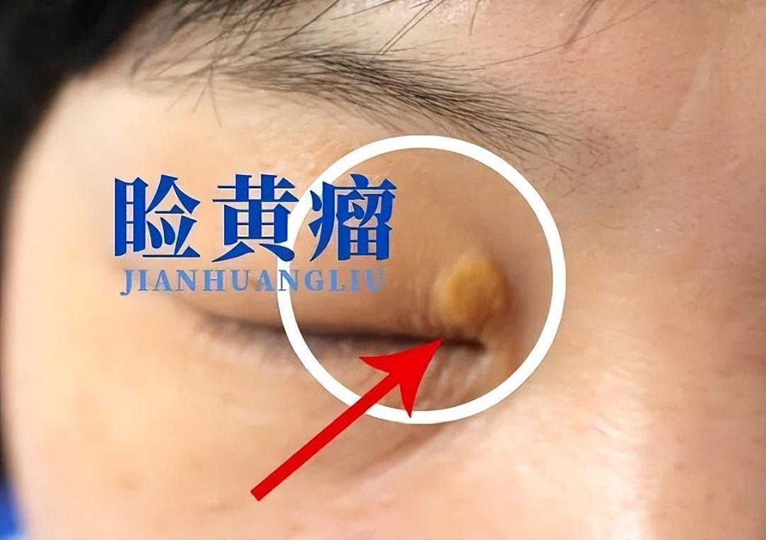  【临床警示】被忽视的脂质沉积体征：五个高血脂早期信号的专业解读 健康养生